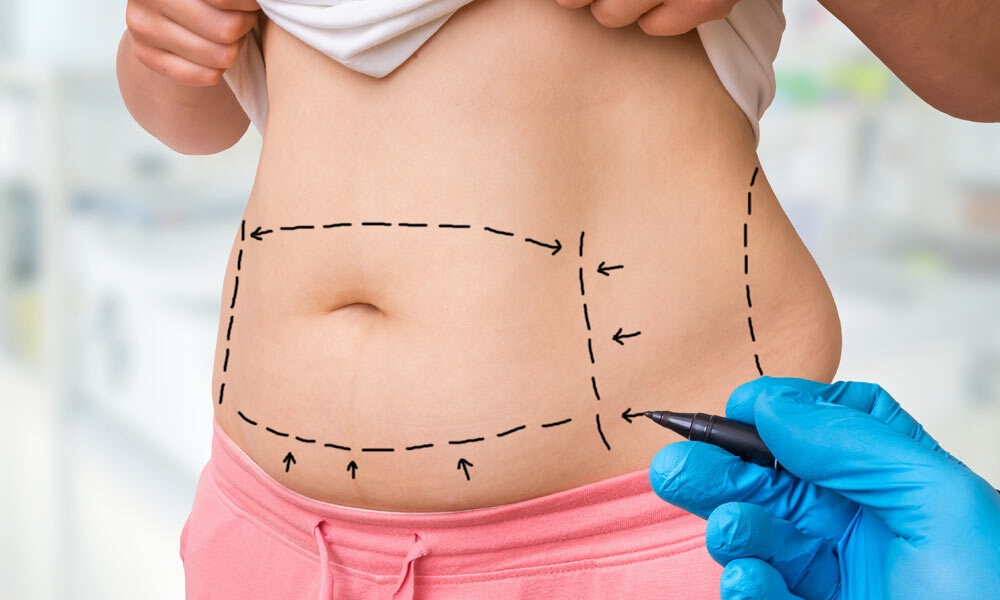 Tummy Tuck Surgery